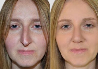 darryl coombes london rhinoplasty before after